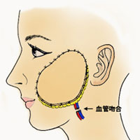 図3　顔面に移植する遊離皮弁のシェーマ