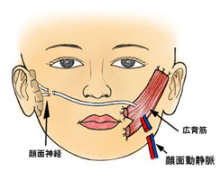 図4　顔面神経麻痺に対する広背筋移植のシェーマ： 広背筋を移植して顔面神経麻痺で失われた 「笑い表情」を再建する手術